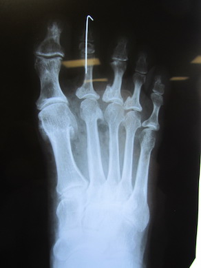 Toes_X-ray.jpg