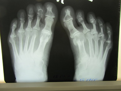 toes_Xray_before.jpg